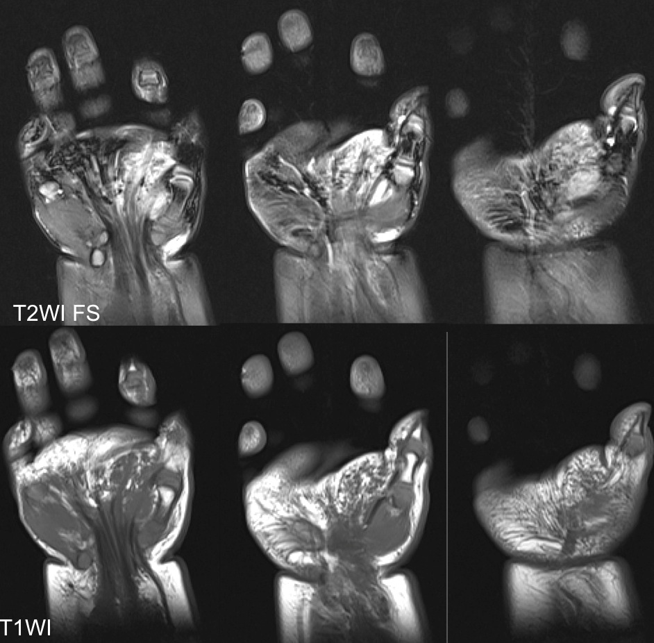 Figure 2 for case Fibrous hamartoma of infancy